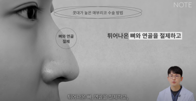 Gangnam Male Nose Surgery, Hump Nose Rhinoplasty, a Place Known for Good Natural Nose Surgery Recommendation: What Is the Hump Nose Surgery Method at Note Plastic Surgery in Nonhyeon? image 10