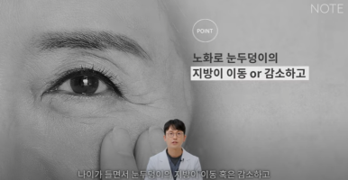 꺼진 눈이 생기는 이유는 따로 있다? 강남 눈성형 잘하는 곳 추천 노트성형외과의 눈꺼짐 해결을 위한 쌍커풀성형과 눈매교정, 지방이식수술 관련 이미지 17