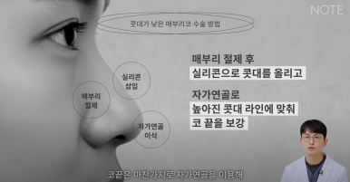 Gangnam Male Nose Surgery, Hump Nose Rhinoplasty, a Place Known for Good Natural Nose Surgery Recommendation: What Is the Hump Nose Surgery Method at Note Plastic Surgery in Nonhyeon? image 16