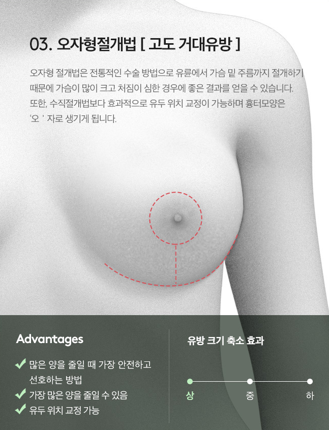 [Note Plastic Surgery] Let’s Learn About Breast Reduction! image 4