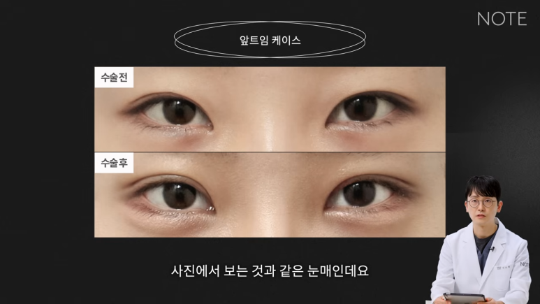 강남 트임수술 쌍꺼풀 눈성형 잘하는 곳 추천 논현 노트성형외과의 트임을 하는 이유, 앞트임이란? 관련 이미지 4