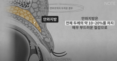 강남 눈성형외과 추천 눈수술 잘하는 곳 논현역 노트성형외과의 두꺼운 눈두덩이 눈위지방이 많다면? 관련 이미지 6