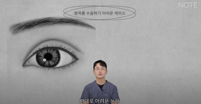 논현 눈성형외과 유명한 곳 강남역 눈성형 노트성형외과의 쌍수 어려운 케이스는? 눈재수술, 안검하수 졸린눈 관련 이미지 3