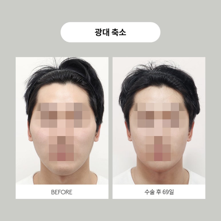 Contours for Men, Note Plastic Surgery Men’s Contouring image 3