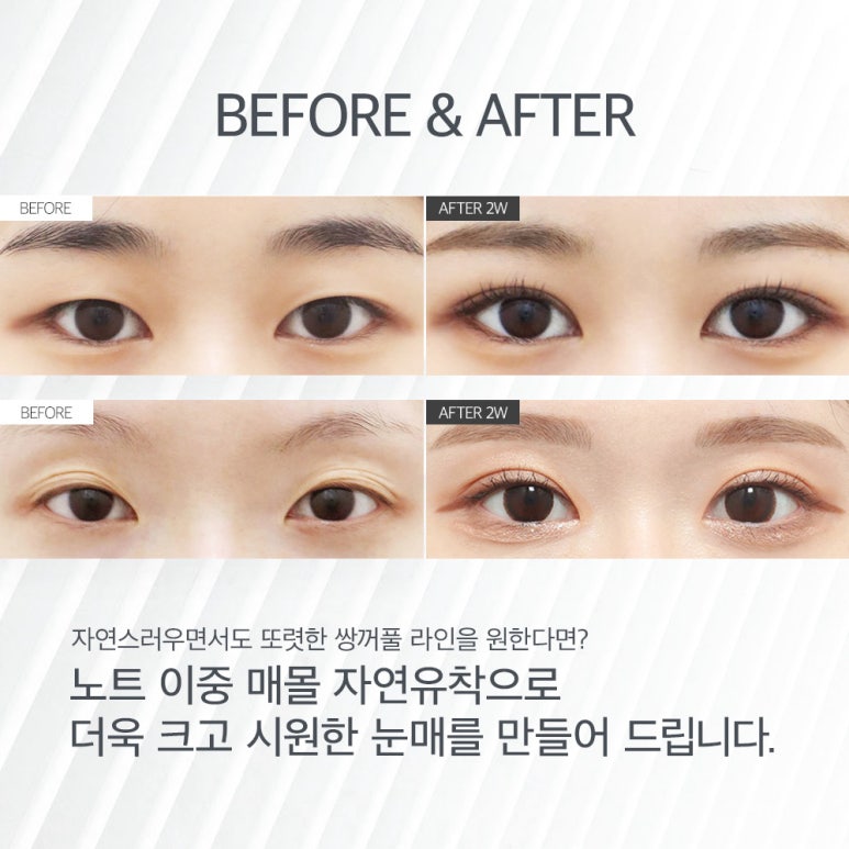 쌍꺼풀수술 전후로 확인하는 쌍꺼풀 비용보다 중요한 논현역 눈성형 잘하는 병원 노트성형외과의 이중 매몰 자연유착 쌍꺼풀수술 포인트 관련 이미지 7