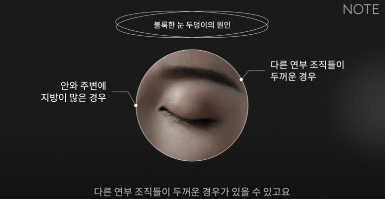 강남 눈성형외과 쌍꺼풀수술 잘하는 곳 논현역 노트성형외과의 불룩한 눈두덩이 원인과 적합한 케이스별 쌍수 방법은? 관련 이미지 12