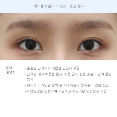 A Review of Revision Eyelid Surgery That Speaks for Itself: A Famous Eyelid Surgery Clinic Near Nonhyeon Station, Note Plastic Surgery’s Final Revision Eyelid Surgery Recommendations and Case Explanations image 5