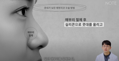 Gangnam Male Nose Surgery, Hump Nose Rhinoplasty, a Place Known for Good Natural Nose Surgery Recommendation: What Is the Hump Nose Surgery Method at Note Plastic Surgery in Nonhyeon? image 14