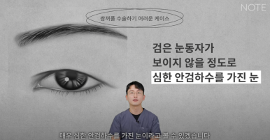 논현 눈성형외과 유명한 곳 강남역 눈성형 노트성형외과의 쌍수 어려운 케이스는? 눈재수술, 안검하수 졸린눈 관련 이미지 7