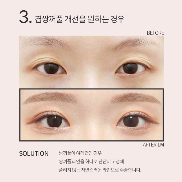 강남 눈성형외과 유명한 곳 추천 노트성형외과의 쌍꺼풀수술 전후는? 올인원 눈성형으로 매몰쌍수와 트임수술을 한번에! 관련 이미지 11