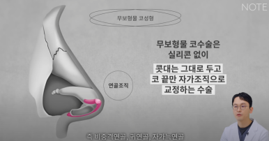 강남 코성형외과 코수술 잘하는 곳 추천 논현역 노트성형외과의 무보형물 자가연골 코성형수술로 자연스러운 코성형 관련 이미지 10