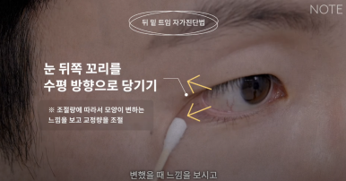 Gangnam Eye Plastic Surgery Clinic: A place that does eye corner surgery well, Nonhyeon Station Note Plastic Surgery explains—Is my eye suitable for corner surgery? Epicanthoplasty, outer canthoplasty, and lower canthoplasty image 16