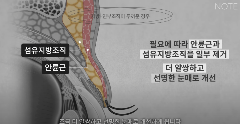 강남 눈성형외과 추천 눈수술 잘하는 곳 논현역 노트성형외과의 두꺼운 눈두덩이 눈위지방이 많다면? 관련 이미지 23