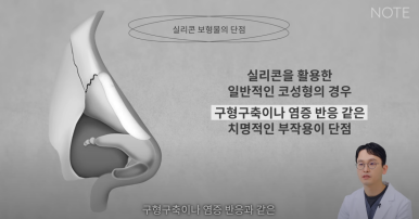 Recommended Gangnam Rhinoplasty Clinic: About Implant-Free Rhinoplasty and Standard Rhinoplasty, as explained by Note Plastic Surgery in Nonhyeon, where nose surgery is done well image 9