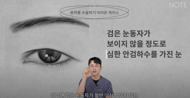 논현 눈성형외과 유명한 곳 강남역 눈성형 노트성형외과의 쌍수 어려운 케이스는? 눈재수술, 안검하수 졸린눈 관련 이미지 6