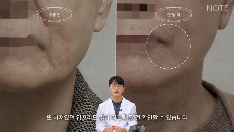 논현 리프팅 안면거상술 유명한 곳 추천 강남 노트성형외과의 안면거상 케이스 리뷰 수술 후 한 달 차 관련 이미지 11