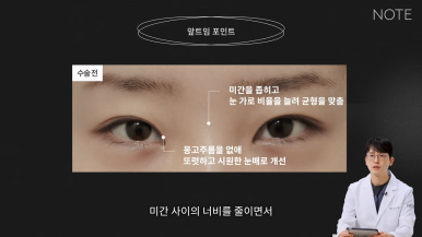강남 트임수술 쌍꺼풀 눈성형 잘하는 곳 추천 논현 노트성형외과의 트임을 하는 이유, 앞트임이란? 관련 이미지 6