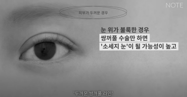Recommended Gangnam Eye Plastic Surgery Clinic for Double Eyelid Surgery: What If You Have Thick Skin at Nonhyeon Note Plastic Surgery? Secondary Revision for Sausage Eyes! Forehead Lift! image 6