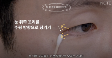 Gangnam Eye Plastic Surgery Clinic: A place that does eye corner surgery well, Nonhyeon Station Note Plastic Surgery explains—Is my eye suitable for corner surgery? Epicanthoplasty, outer canthoplasty, and lower canthoplasty image 14