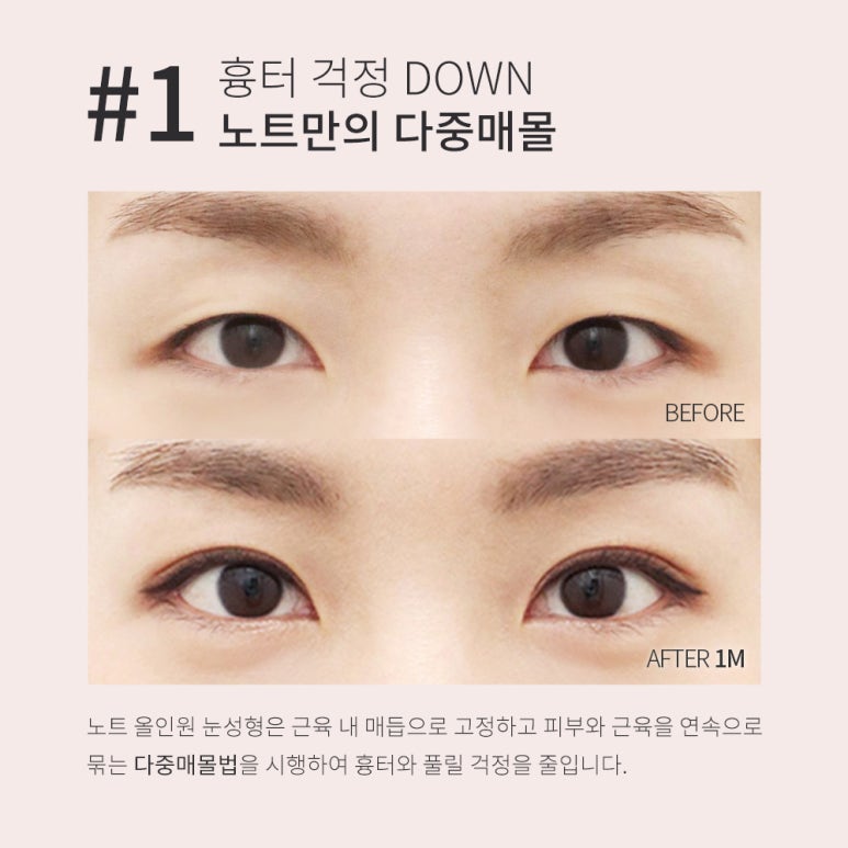 강남 눈성형외과 유명한 곳 추천 노트성형외과의 쌍꺼풀수술 전후는? 올인원 눈성형으로 매몰쌍수와 트임수술을 한번에! 관련 이미지 4
