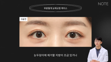 Recommended Place for Double Eyelid Surgery in Gangnam: What Is Partial-Incision Ptosis Correction at Nonhyeon NOTE Plastic Surgery? image 5
