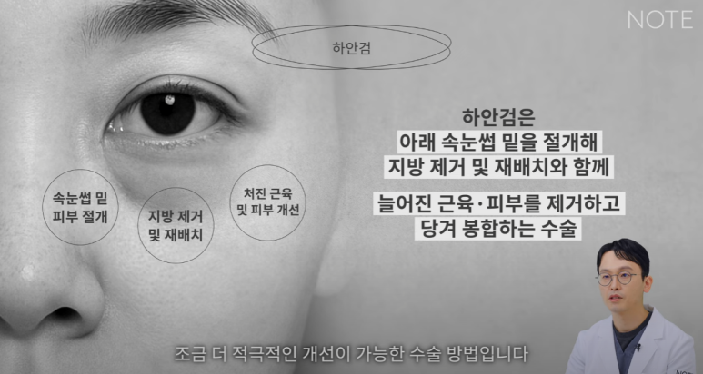 논현 눈성형외과 추천 하안검수술 눈밑지방재배치 잘하는 곳 강남 노트성형외과의 중년 눈성형 케이스 비교 분석 관련 이미지 14