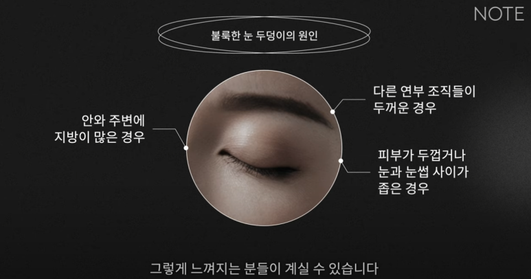 강남 눈성형외과 쌍꺼풀수술 잘하는 곳 논현역 노트성형외과의 불룩한 눈두덩이 원인과 적합한 케이스별 쌍수 방법은? 관련 이미지 15