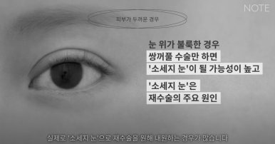 Recommended Gangnam Eye Plastic Surgery Clinic for Double Eyelid Surgery: What If You Have Thick Skin at Nonhyeon Note Plastic Surgery? Secondary Revision for Sausage Eyes! Forehead Lift! image 8