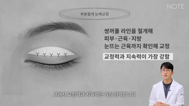 논현 쌍꺼풀수술 눈성형 유명한 곳 추천 강남 노트성형외과의 절개 눈매교정이란? 관련 이미지 3