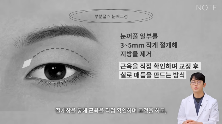 Recommended Place for Double Eyelid Surgery in Gangnam: What Is Partial-Incision Ptosis Correction at Nonhyeon NOTE Plastic Surgery? image 3
