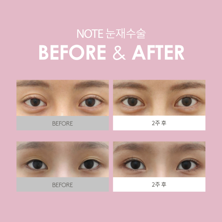 강남 쌍꺼풀재수술, 실패없는 내 눈을 위한 마지막 눈성형, 논현 눈성형 잘하는 곳 노트성형외과 맞춤 눈재수술 관련 이미지 5