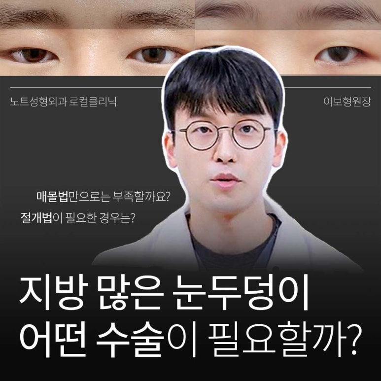 강남 눈성형외과 추천 눈수술 잘하는 곳 논현역 노트성형외과의 두꺼운 눈두덩이 눈위지방이 많다면? 관련 이미지 1
