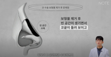 Recommended Gangnam Rhinoplasty Clinic: A Guide to Nose Surgery at Nonhyeon Note Plastic Surgery, Including Post-Rhinoplasty Inflammation and Implant Removal image 18