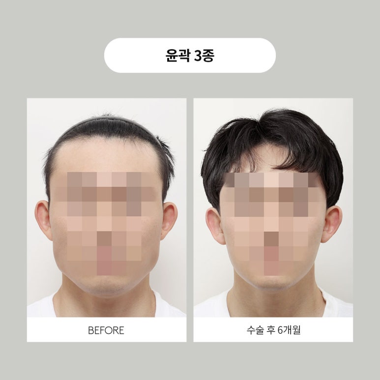 Contours for Men, Note Plastic Surgery Men’s Contouring image 5