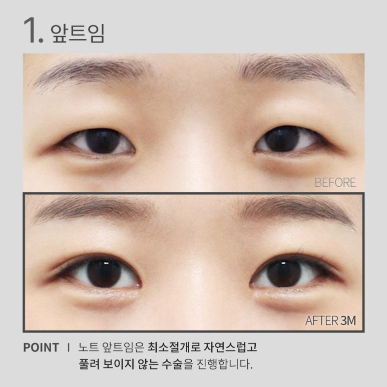 논현 눈성형 잘하는 곳 노트성형외과의 눈앞트임, 뒤트임, 밑트임, 듀얼트임까지! 트임성형 효과 확실한 눈트임수술 관련 이미지 4