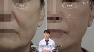 논현 리프팅 안면거상술 유명한 곳 추천 강남 노트성형외과의 안면거상 케이스 리뷰 수술 후 한 달 차 관련 이미지 9