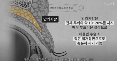 강남 눈성형외과 추천 눈수술 잘하는 곳 논현역 노트성형외과의 두꺼운 눈두덩이 눈위지방이 많다면? 관련 이미지 8
