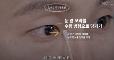 Gangnam Eye Plastic Surgery Clinic: A place that does eye corner surgery well, Nonhyeon Station Note Plastic Surgery explains—Is my eye suitable for corner surgery? Epicanthoplasty, outer canthoplasty, and lower canthoplasty image 12