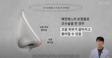 논현역 코수술 추천 코성형 잘하는 곳 강남 노트성형외과의 코수술 후 실리콘 보형물 교체를 해야하는 경우는? 관련 이미지 18