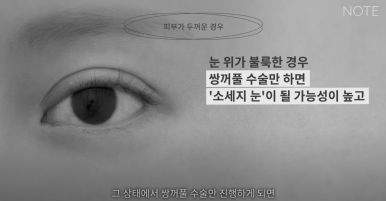 Recommended Gangnam Eye Plastic Surgery Clinic for Double Eyelid Surgery: What If You Have Thick Skin at Nonhyeon Note Plastic Surgery? Secondary Revision for Sausage Eyes! Forehead Lift! image 5