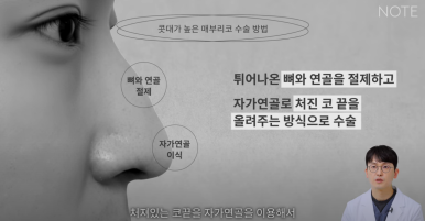 Gangnam Male Nose Surgery, Hump Nose Rhinoplasty, a Place Known for Good Natural Nose Surgery Recommendation: What Is the Hump Nose Surgery Method at Note Plastic Surgery in Nonhyeon? image 11