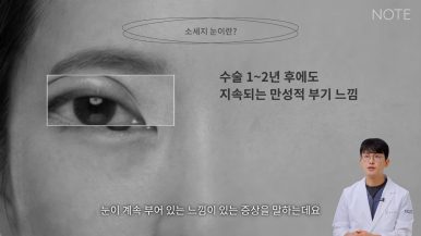 Nonhyeon Revision Eyelid Surgery Plastic Surgery, Famous for Eye Surgery in Gangnam: What Is the “Sausage Eye” Double Eyelid Surgery Side Effect, Says NOTE Plastic Surgery? image 3