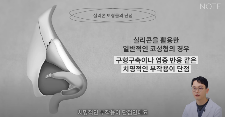 Recommended Gangnam Rhinoplasty Clinic: About Implant-Free Rhinoplasty and Standard Rhinoplasty, as explained by Note Plastic Surgery in Nonhyeon, where nose surgery is done well image 10