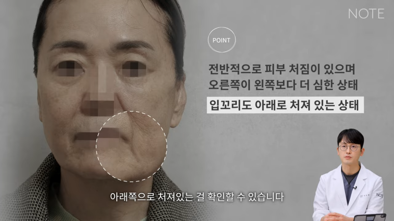 논현 안면거상 성형외과 리프팅 유명한 곳 강남 노트성형외과의 안면거상 케이스 리뷰 수술 전 고민 관련 이미지 9