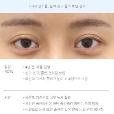 A Review of Revision Eyelid Surgery That Speaks for Itself: A Famous Eyelid Surgery Clinic Near Nonhyeon Station, Note Plastic Surgery’s Final Revision Eyelid Surgery Recommendations and Case Explanations image 6