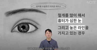 논현 눈성형외과 유명한 곳 강남역 눈성형 노트성형외과의 쌍수 어려운 케이스는? 눈재수술, 안검하수 졸린눈 관련 이미지 5