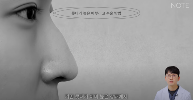 Gangnam Male Nose Surgery, Hump Nose Rhinoplasty, a Place Known for Good Natural Nose Surgery Recommendation: What Is the Hump Nose Surgery Method at Note Plastic Surgery in Nonhyeon? image 8