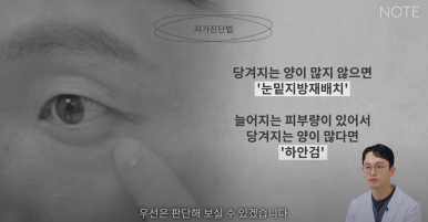 논현 눈수술 성형외과 유명한 곳 눈밑지방재배치 추천 강남 노트성형외과의 눈밑지하안검을 구분하는 자가진단법? 관련 이미지 9