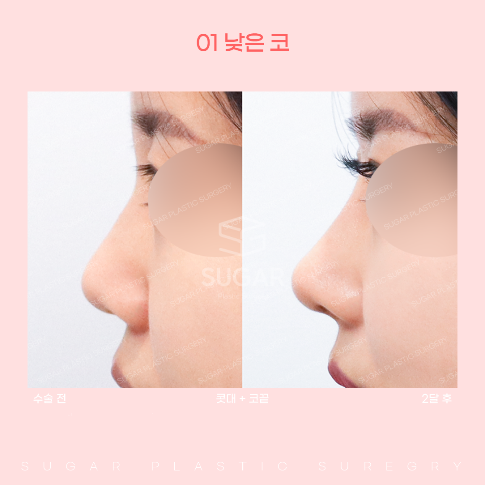 코 유형에 따른 코성형 방법 관련 이미지 4