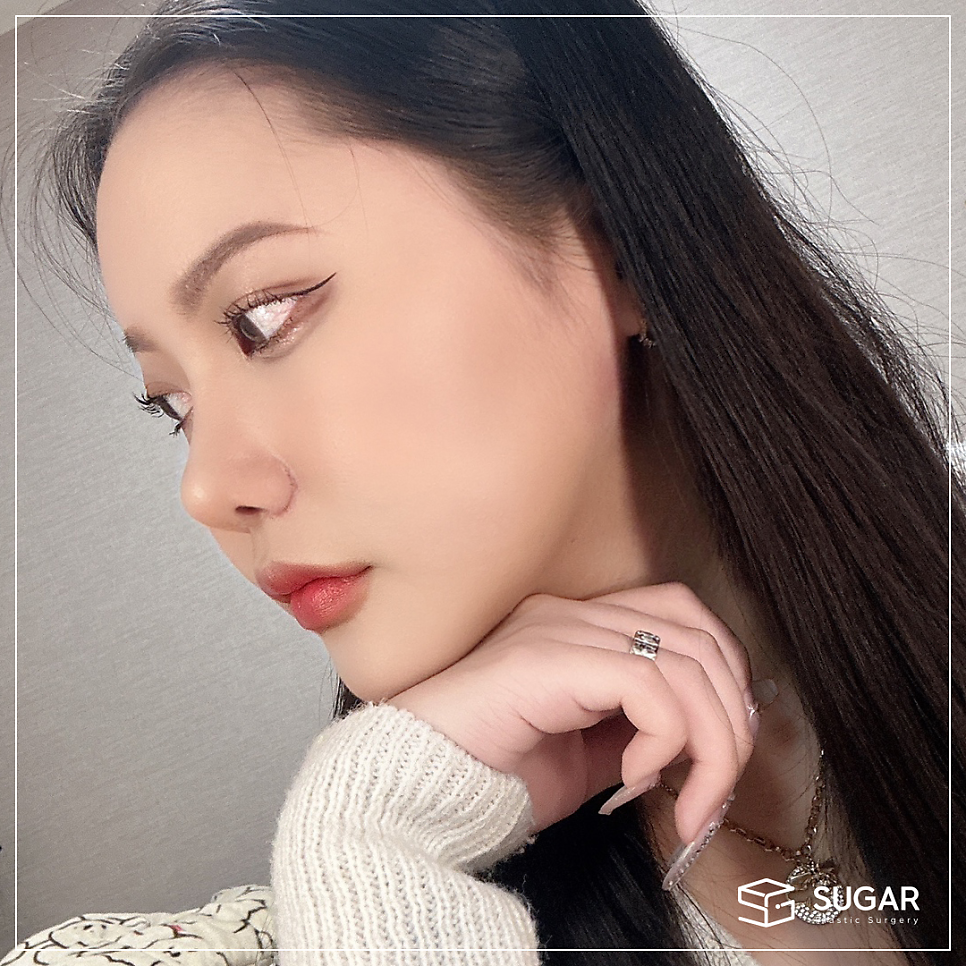 코 유형에 따른 코성형 방법 관련 이미지 16